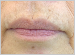 ちりめんじわのヒアルロン酸治療・施術前