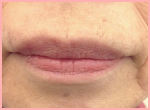 ちりめんじわのヒアルロン酸治療・施術後1週間