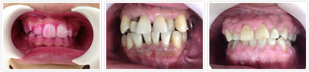 iPadを見ながらわかりやすいブラッシング指導。