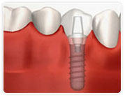 3. 修復物の装着