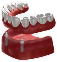 失った歯の本数分インプラント手術をする必要はありません。