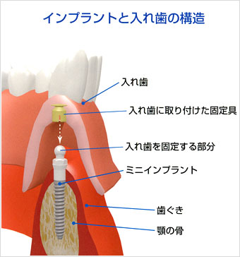 インプラントと入れ歯の構造