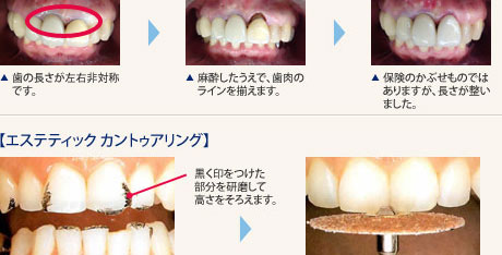 【歯の長さの調整】歯の長さが左右非対称の場合、麻酔したうえで歯肉のラインを揃えます。保険のかぶせものではありますが、長さが整いました。　【エステティックカントゥアリング】黒く印をつけた部分を研磨して高さをそろえます。